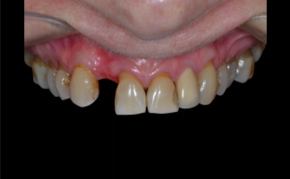 Rehabilitación dento-alveolar