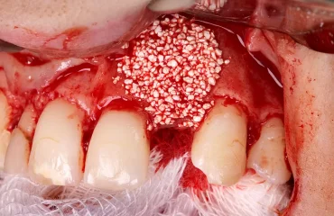 Regeneración ósea guiada en área estética Regeneración ósea guiada en área estética